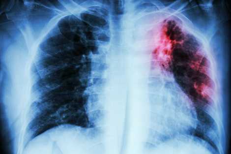 Consult Dr. Manoj Maske, the best Pulmonologist for Interstitial Lung Disease treatment in Thane West, Mumbai, ensuring personalized care for lung health treatment.